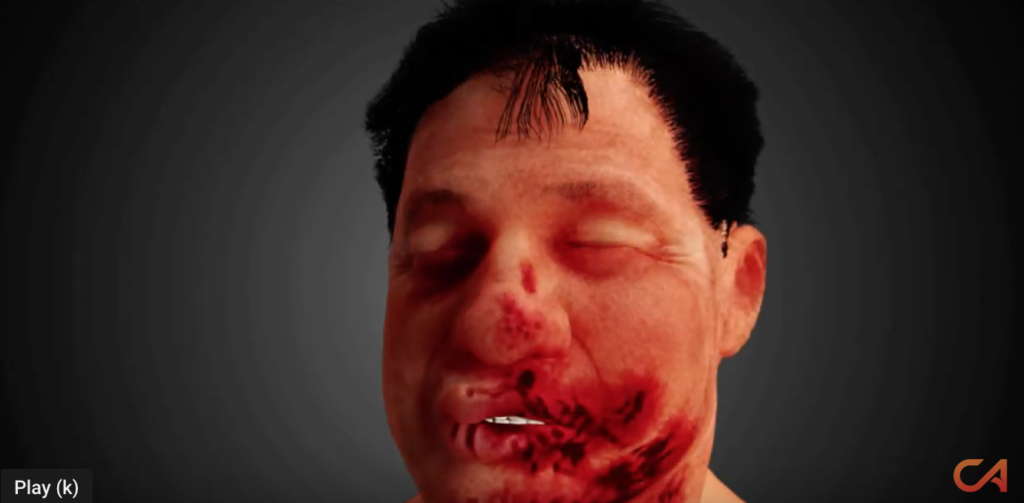 Traumatic Brain Injury