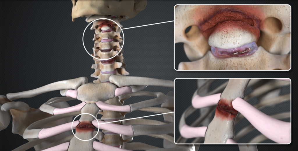 3D Medical Animation Services Sample from Courtroom Animation