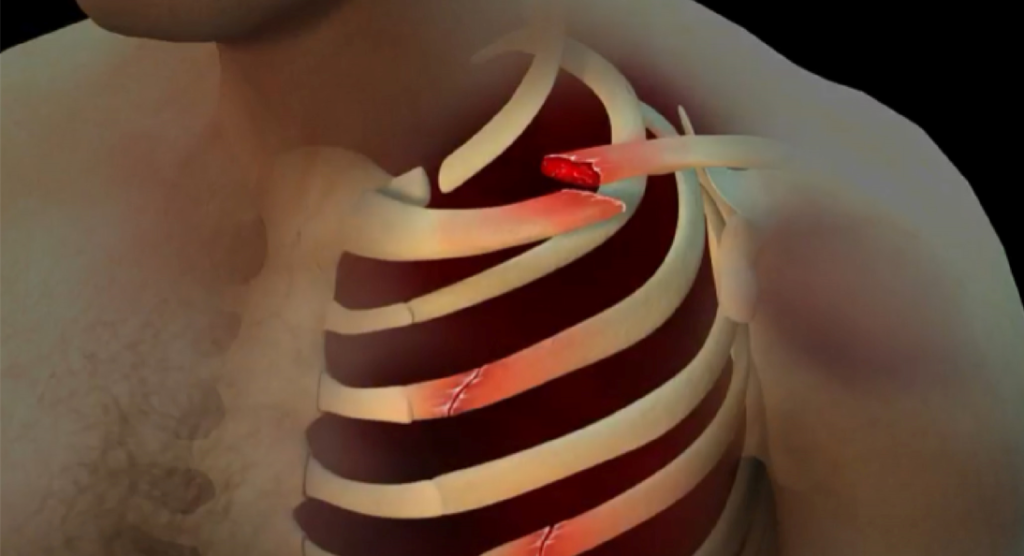 Medical Graphic Sample from Courtroom Animation