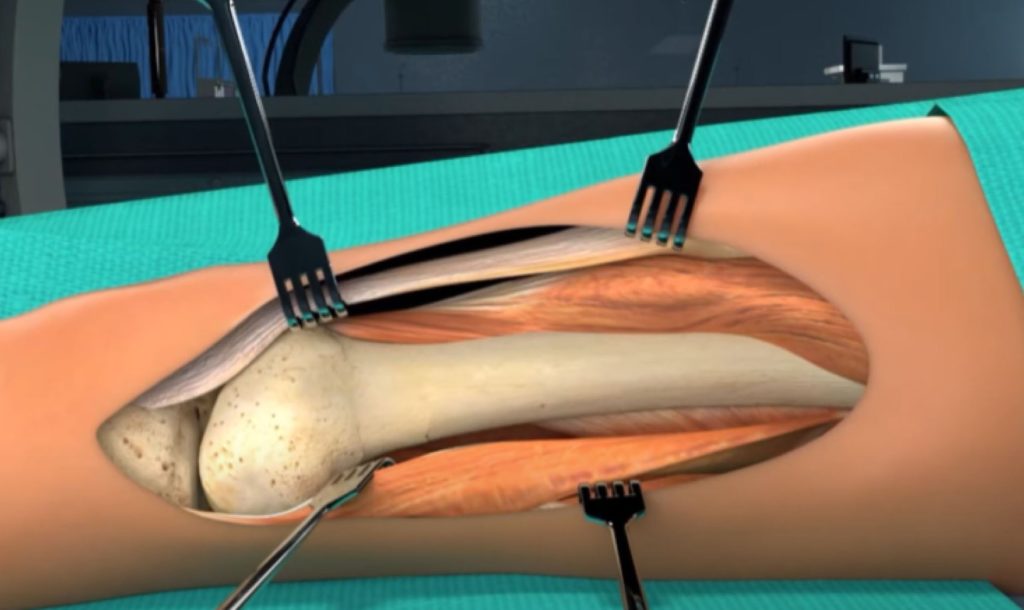 Sample Medical Graphic from Courtroom Animation