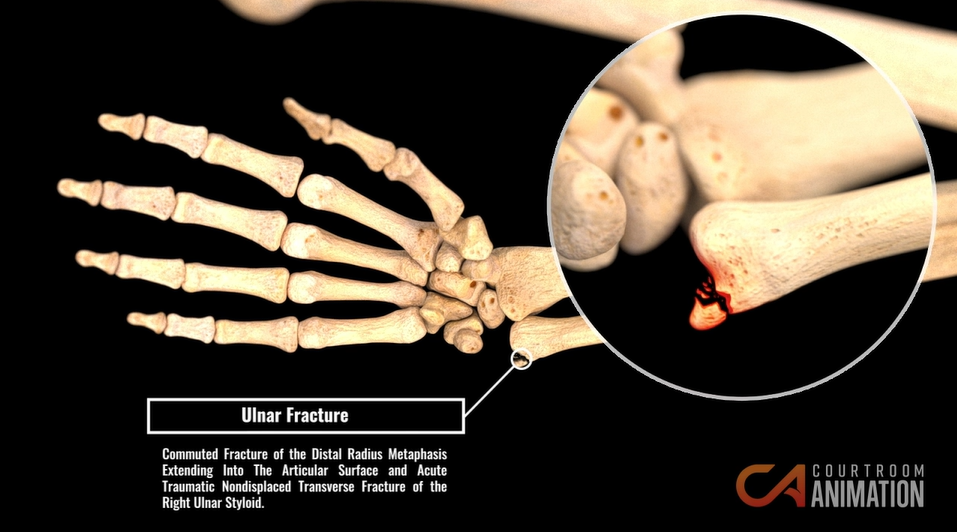 Litigation Graphic Shows Wrist Injury and Ulnar Fracture terms