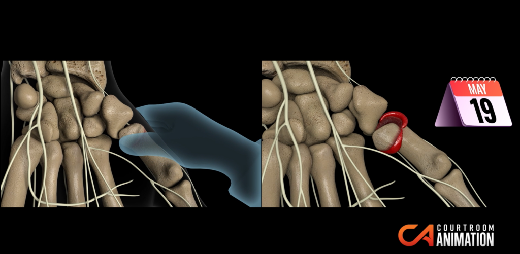 Medical treatment of Bennett fracture preventing CRPS and long term nerve damage