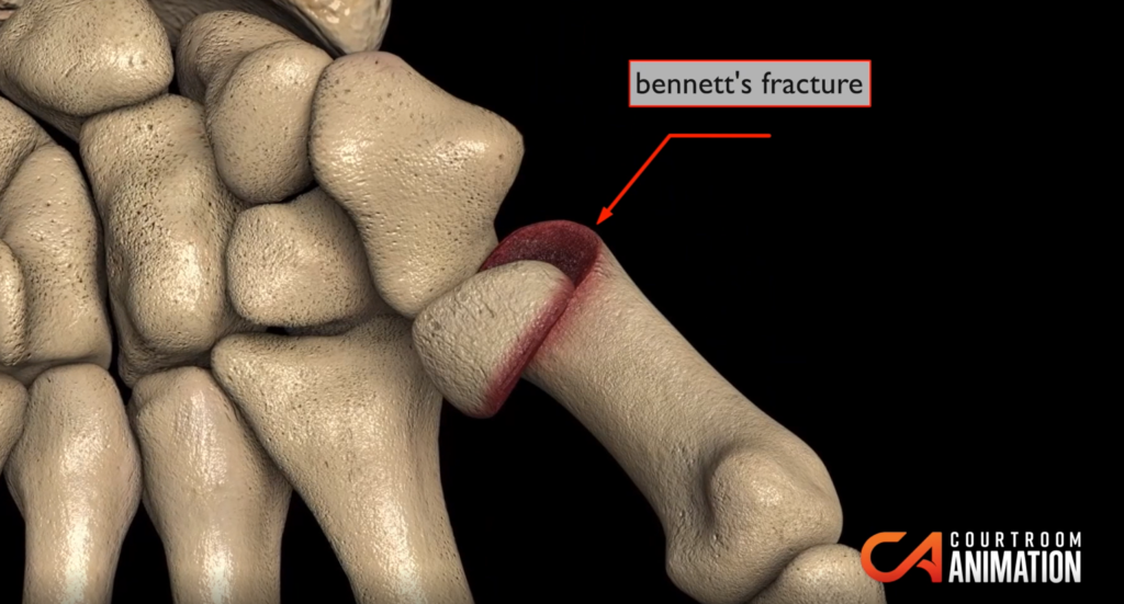 Bennett fracture 