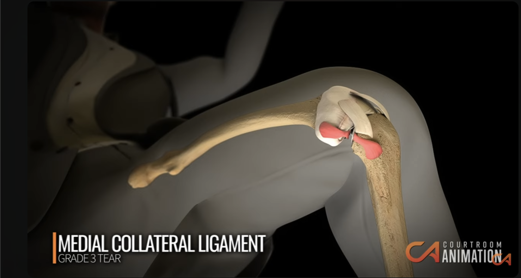 Medial Collateral Alignment Medical Animation